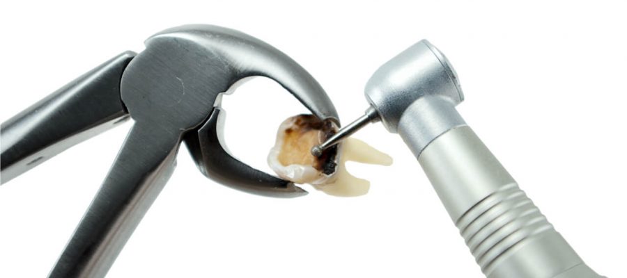 Tooth Resorption Treatment