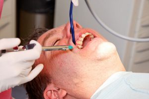 simple tooth extraction