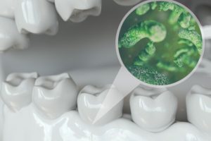 gum disease due to bacteria