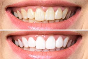 How can I protect my gums during teeth whitening?