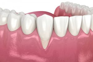 Can I still whiten my teeth if I have gum disease?