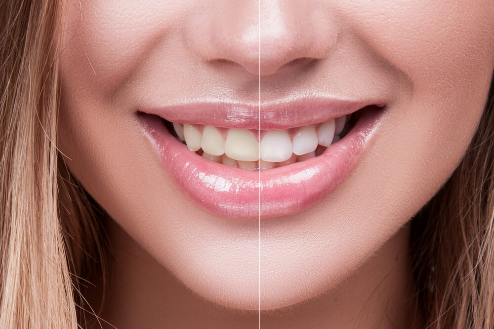 How to Protect Your Teeth while Whitening: Gum Protection Tips